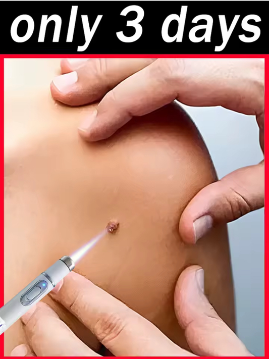 Wart remover